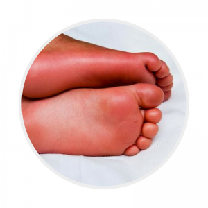 KD CPG Erythema palms soles
